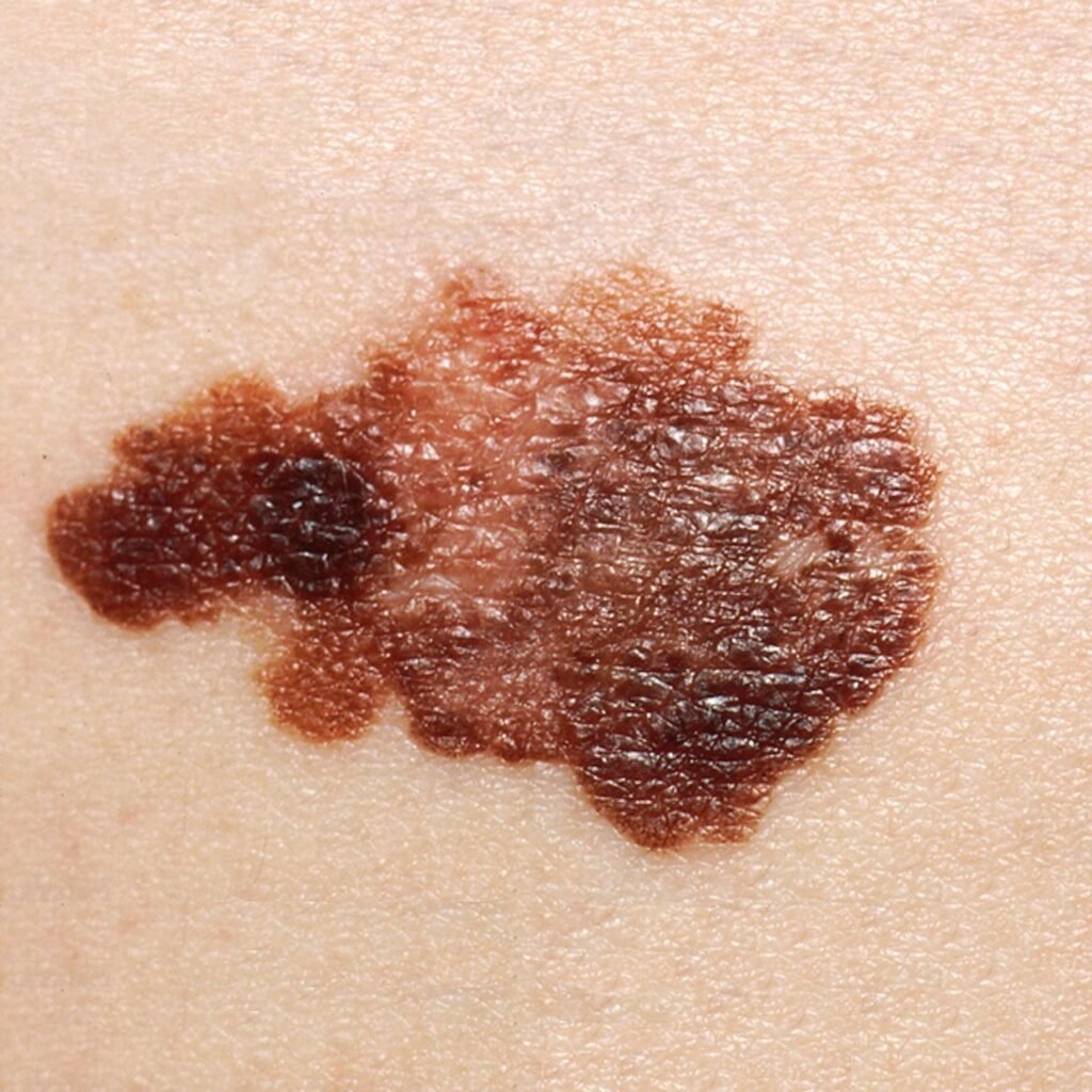 personalized mRNA cancer vaccine